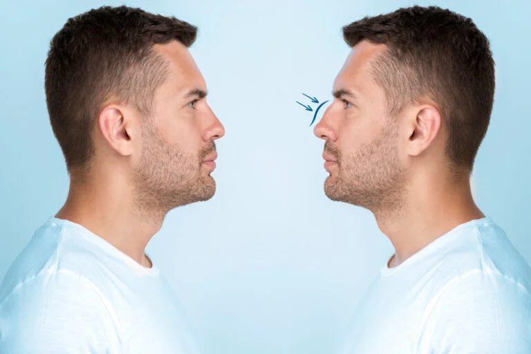 Quanto tempo demora para ver resultado final de rinoplastia? 6 recuperacao da rinoplastia
